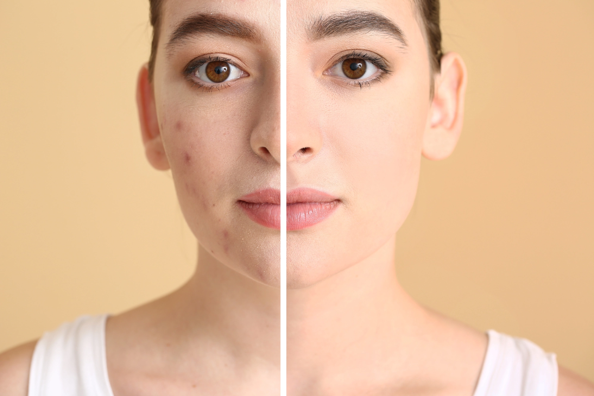 Before and after image of acne treatment.